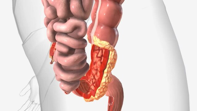Crohns Disease, Thick intestine wall