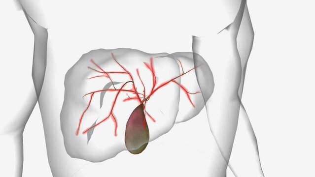 Primary Biliary Cholangitis Cirrhosis 3d animation