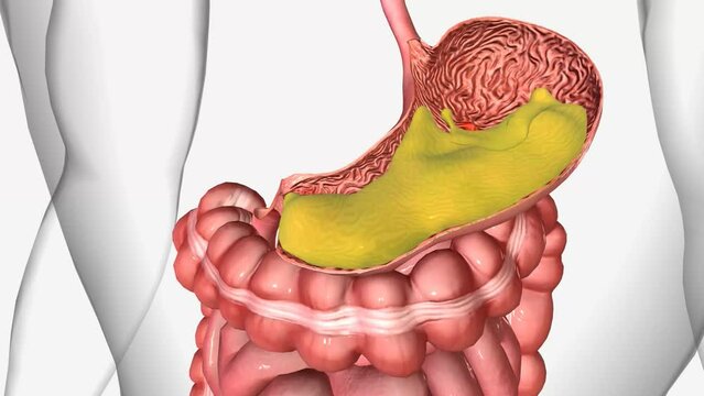 Gastric outlet obstruction (GOO) is a result of any disease process that causes a mechanical impediment to gastric emptying
