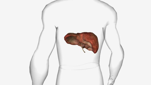 Primary Biliary Cholangitis Cirrhosis 3D
