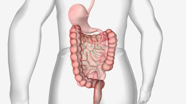 Primary Biliary Cholangitis Cirrhosis 3D