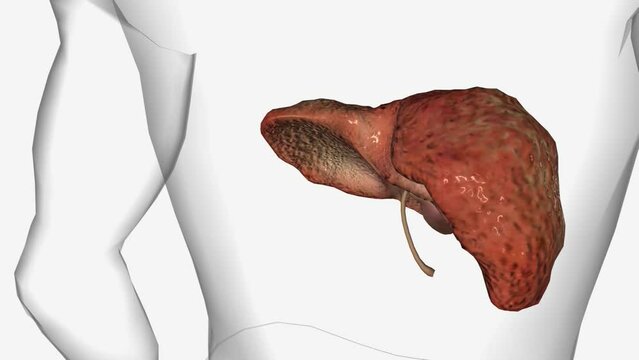 Primary Biliary Cholangitis -Cirrhosis