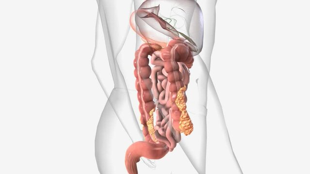Crohn's disease is a type of inflammatory bowel disease (IBD)