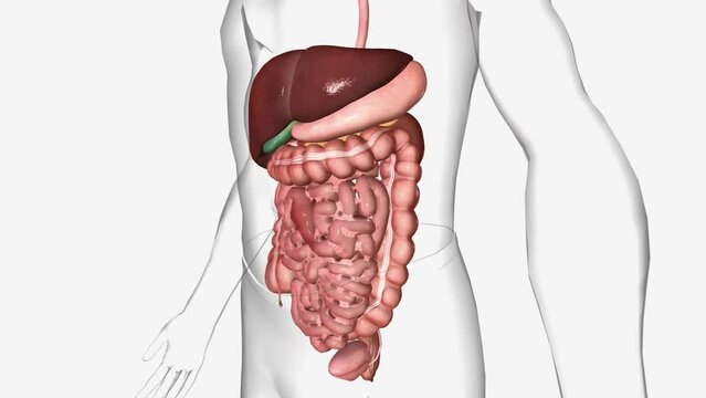 Abdominal adhesions are bands of scar-like tissue that form inside your abdomen