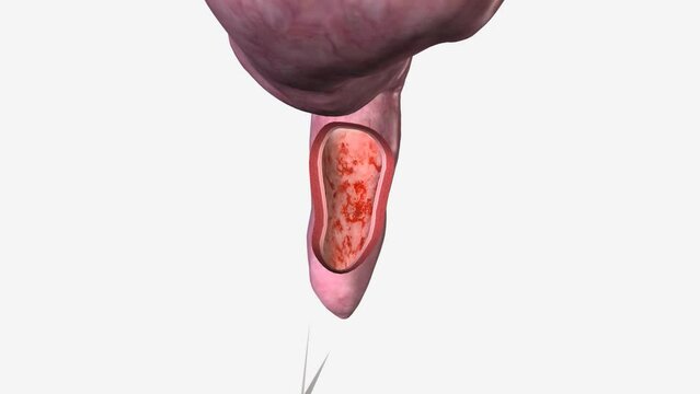 Proctitis is inflammation of the lining of the rectum. Proctitis may be acute or chronic