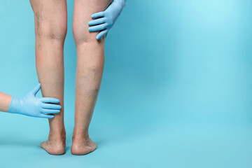 Doctor examining patient with varicose veins on light blue background, closeup. Space for text - obrazy, fototapety, plakaty
