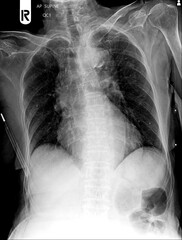 Film chest x-ray PA upright show unknown
