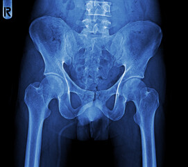Film x-ray of human pelvis and hip joints