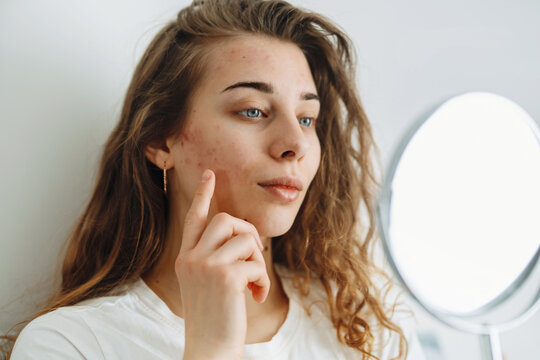 Oung Woman With Problem Skin Looking Into Mirror. Dermatology. Allergic Reaction From Cosmetic, Red Spot Or Rash On Face. 