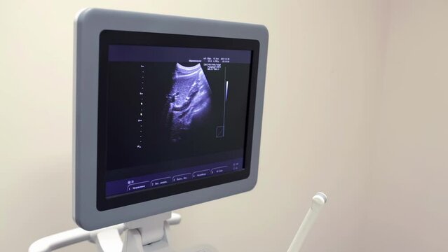High-quality ultrasound monitor performs precise organ examinations, aiding in accurate medical diagnoses.
