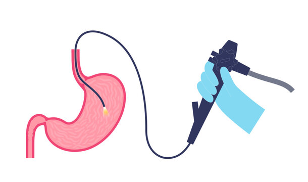 Gastroscopy endoscopy procedure