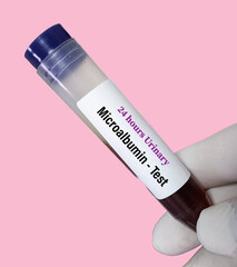 Urine test for 24 hours urinary microalbumin to renal or kidney disease diagnosis.