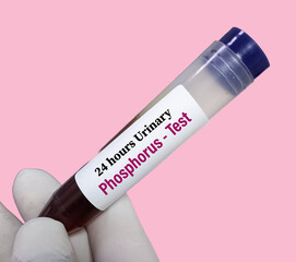 24 hours urine sample for urinary Phosphorus test, Urine Phosphate Test.