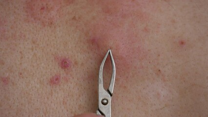 The process of extracting bee sting from the human body. Bee stings for health and healing. Allergy to insect stings, honey bees