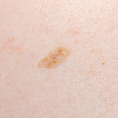 Nevus or mole on the human body close-up. Skin cancer, keratosis or melanoma on the skin.