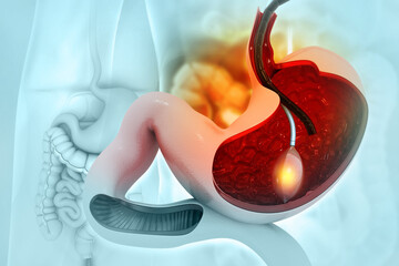 stomach Endoscopy.Gastric Balloon Inside a Stomach.3d illustration - obrazy, fototapety, plakaty