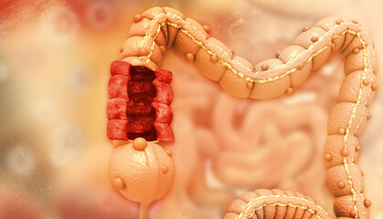 Colon diseases. Colorectal surgery. 3d illustration