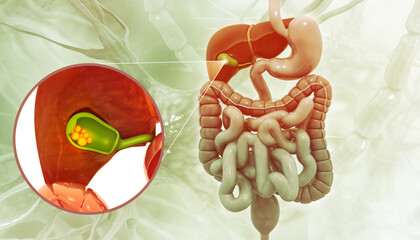 Gallbladder cutting showing gallstones obstructing bile duct on medical background. 3d illustration - obrazy, fototapety, plakaty