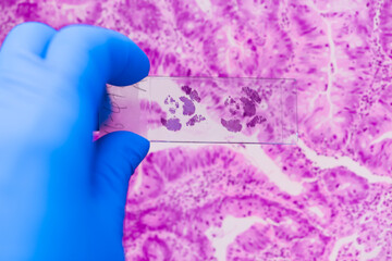 Scientist in blue gloves hand holding glasses slide breast tissue on out of focus cancer tissue...