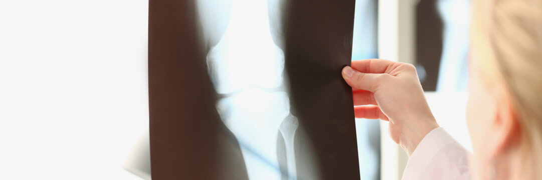 Doctor looks at x-ray film of knee joint before treatment. Image of bone in orthopedic department of hospital concept