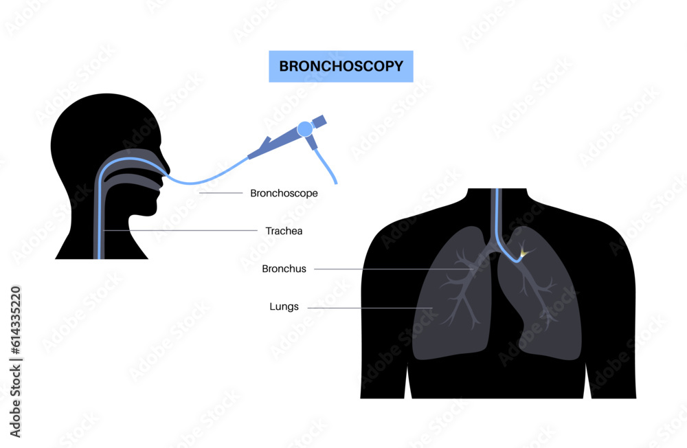 Canvas Prints Bronchoscopy procedure concept