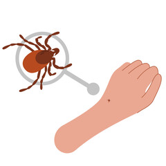 The human hand with the tick bite. Tick bite hand.Tick bite. Healthcare illustration.
