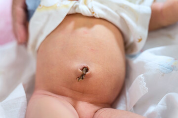 Dry umbilical cord in navel of newborn baby