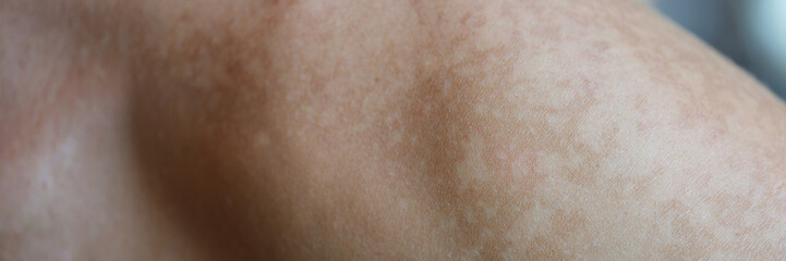 Skin care problem spots on shoulder skin and health concept