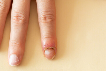 Inflammation of the finger. Managing Finger Inflammation.