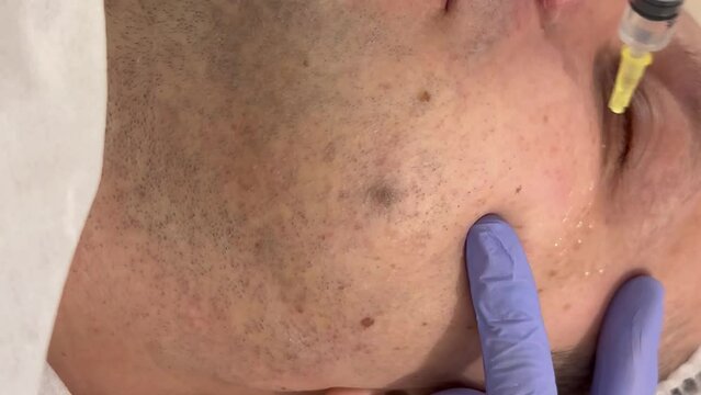 A cosmetologist makes several injections of biorevitalization of the skin of the male face under the eyes, men's face care, reduction of bags and prevention of wrinkles under the eyes. Mesotherapy 