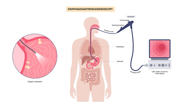 Gastroscopy endoscopy procedure