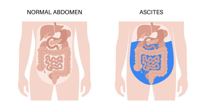 Ascites disease poster