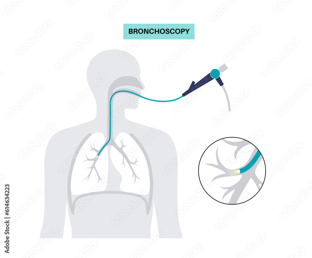 Poster Bronchoscopy procedure concept