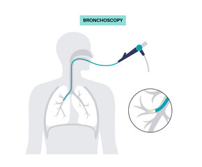 Bronchoscopy procedure concept - 614634223