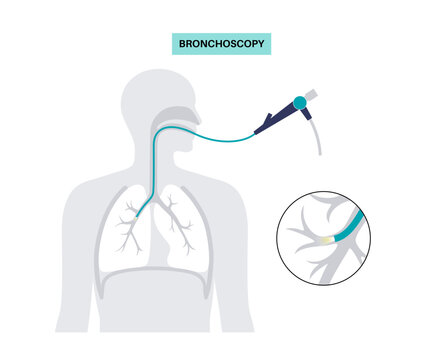 Bronchoscopy procedure concept