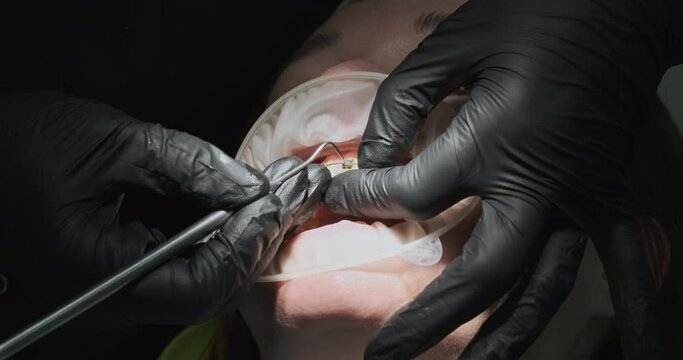 Orthodontist removes the rubber rings from the braces.