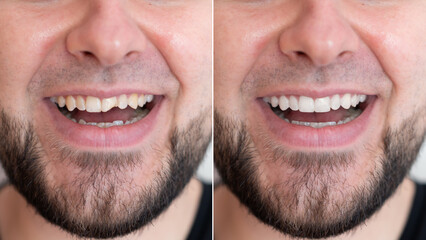 A man with a beard showing the result of his teeth treatment  and whitening - before and after 