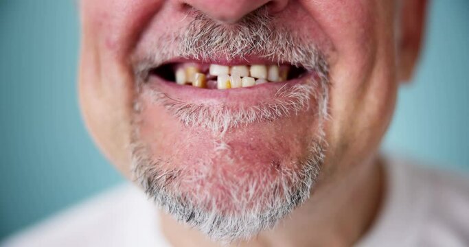 Smile With Missing Tooth