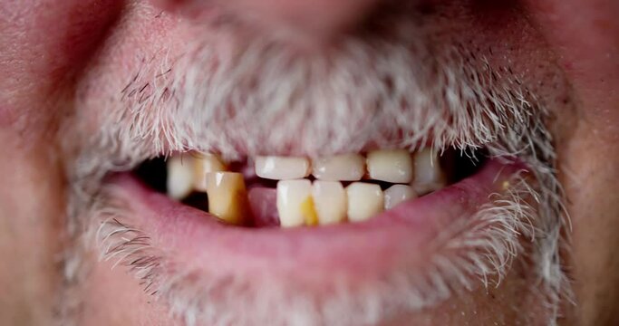 Smile With Missing Tooth