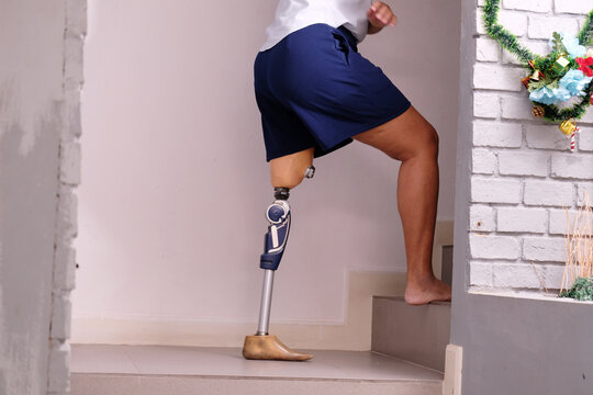 Disabled woman wearing prosthetic legs Prosthetic legs.