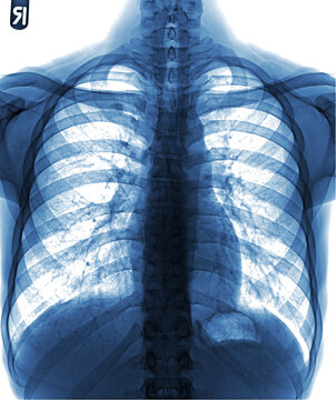 x ray image of chest
