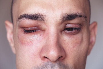 Caucasian man has angioedema around the eyes caused by allergic reaction to agents such as insect...