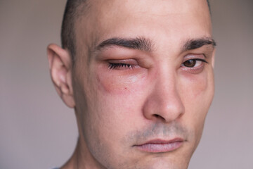 Obraz premium Caucasian man has angioedema around the eyes caused by allergic reaction to agents such as insect bites, foods, or medications. Swollen face, close up.