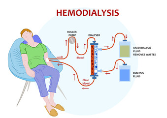 Infographic of hemodialysis, a procedure where a dialysis machine are used to clean blood