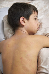 Skin itching, dermatitis, food allergy on the face. A boy with red spots. The child has itching, on the face with an allergic rash.