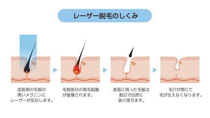 医療レーザー脱毛のしくみと毛周期