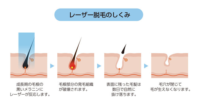 医療レーザー脱毛のしくみと毛周期
