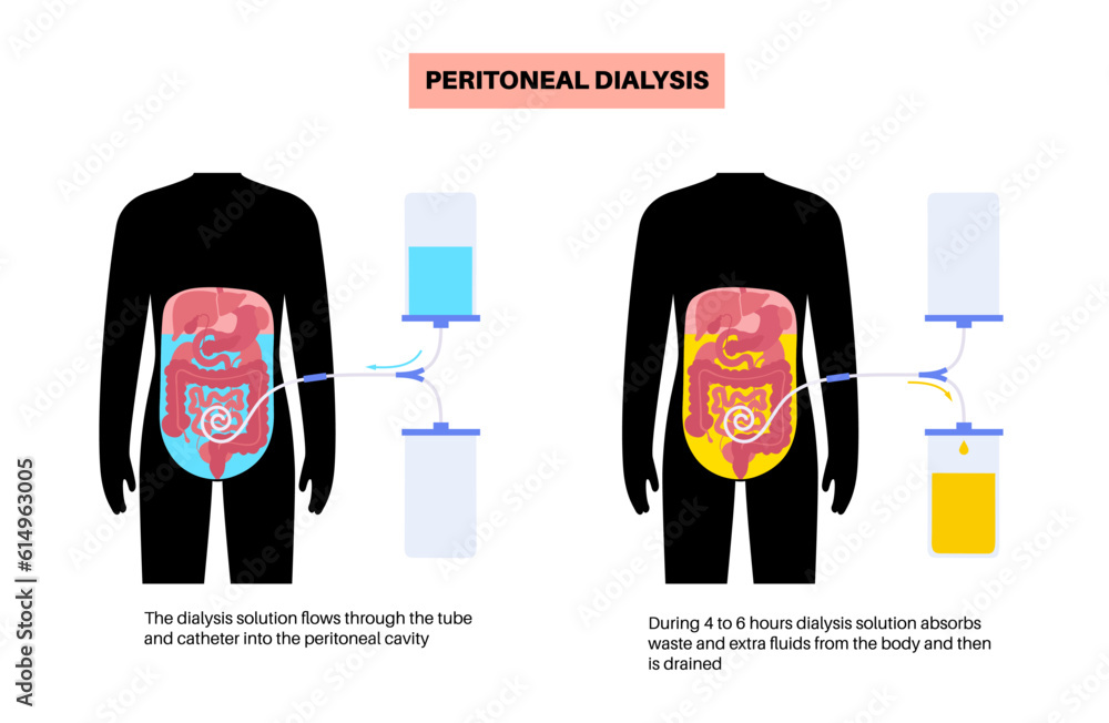 Wall mural Peritoneal dialysis concept