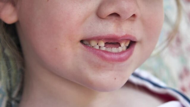 Child's mouth without the top two milk teeth in close-up. Toothless smile of a 6-7 year old girl. Baby teeth care. Missing teeth