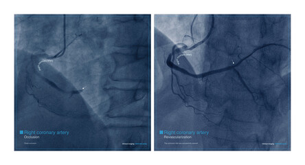 Male, 68 years old, chest pain for 7 hours. Coronary angiography suggests occlusion of the distal right coronary artery. The patient was successfully placed with a coronary stent. - obrazy, fototapety, plakaty